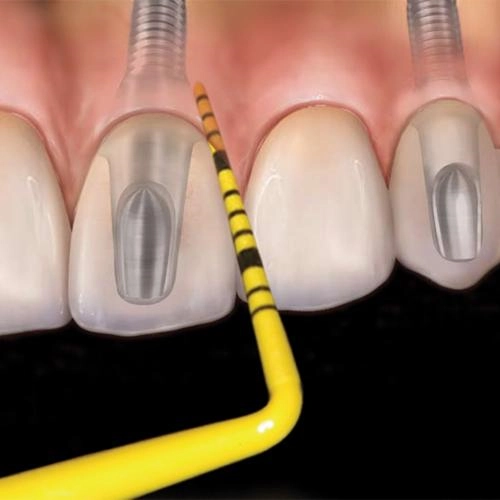 HU-FRIEDY COLORVUE POCKET-SONDE TIPS UNC-12 KIT (1 heft + 7 tips)